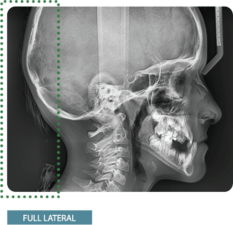 Full Lateral