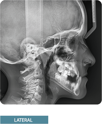 Lateral