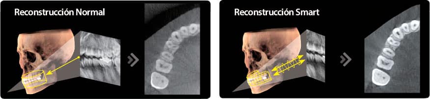 Reconstrucción Smart