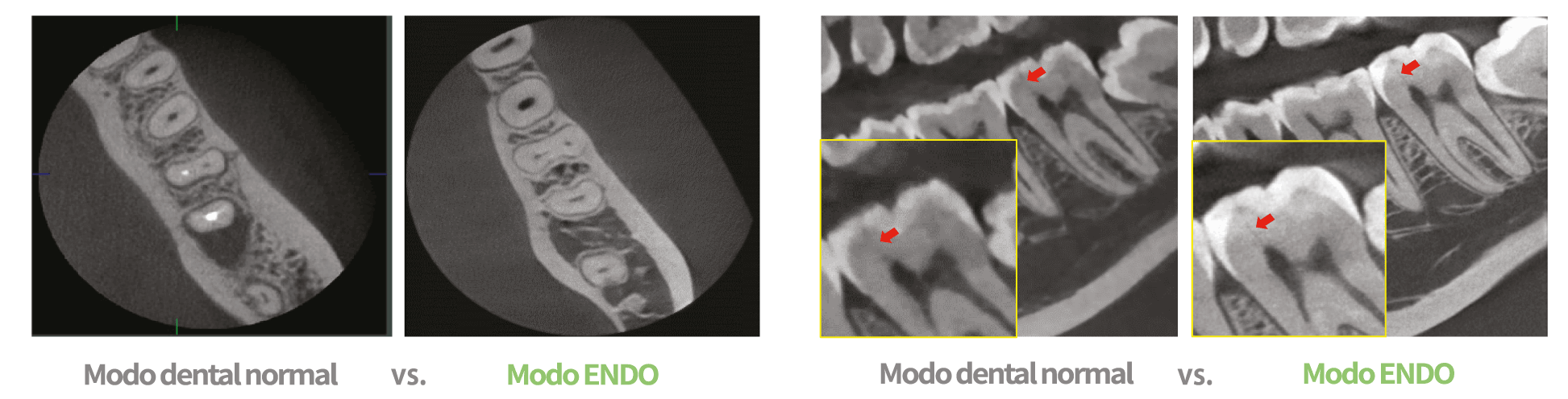Modo ENDO de Alta Resolución