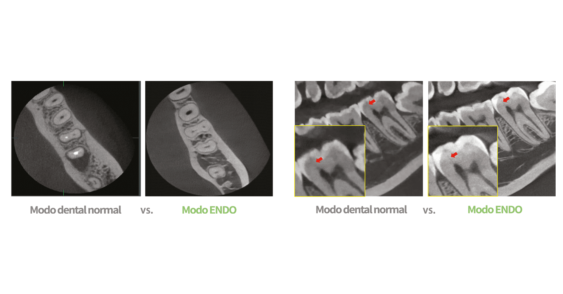 Modo ENDO Alta Resolución