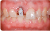 Antes