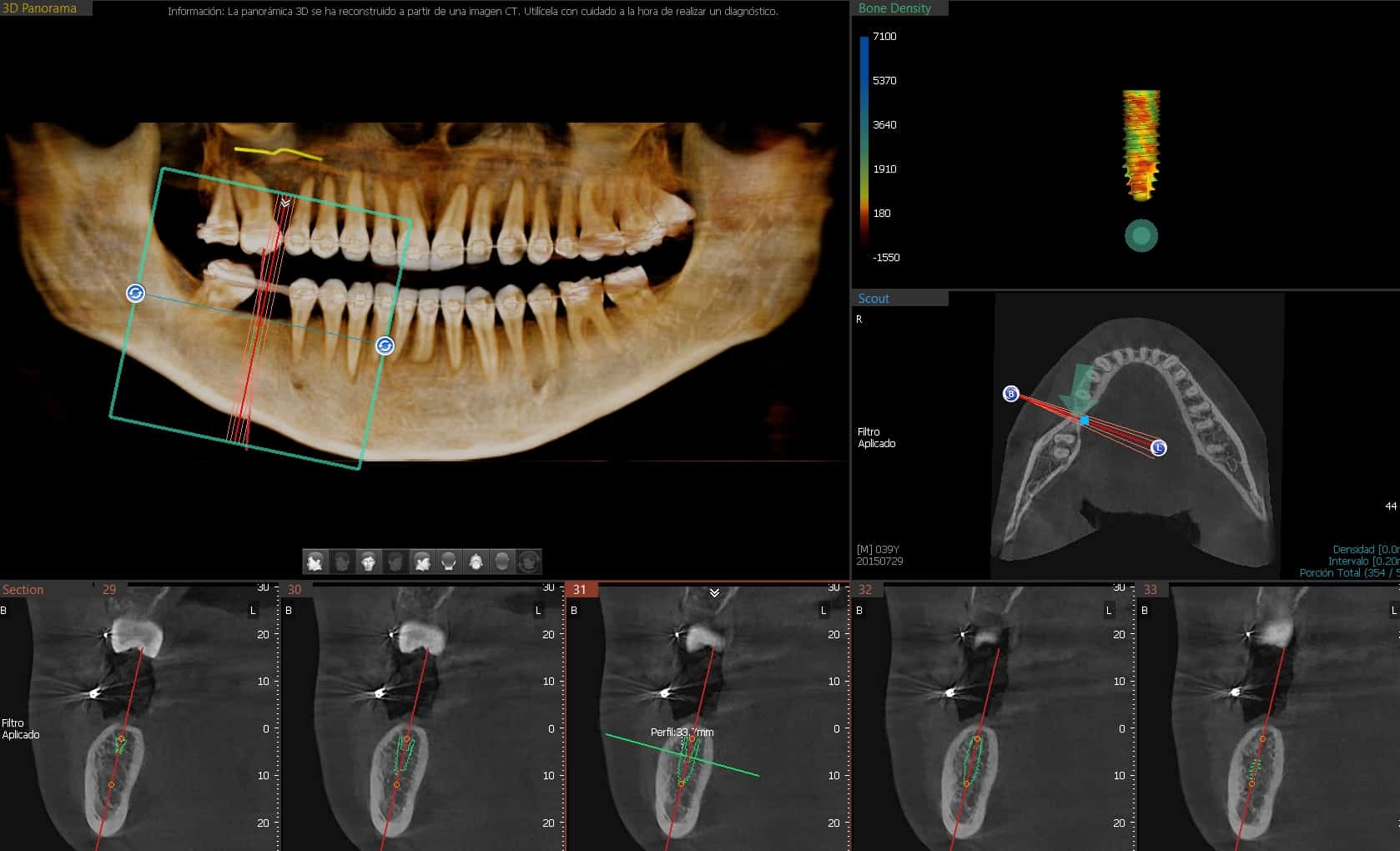 Modo ENDO de Alta Resolución